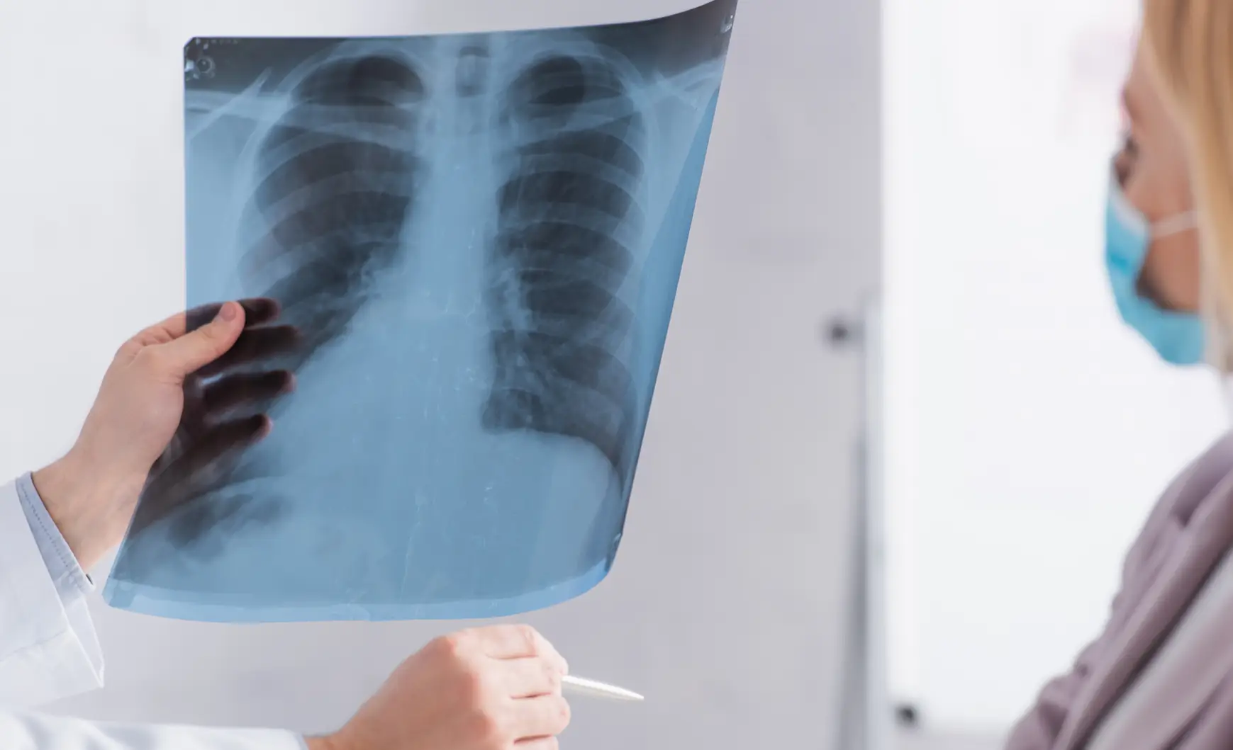 Fotografía detalle de una mano sosteniendo una radiografia pulmonar con sintomas de bronquiectasia