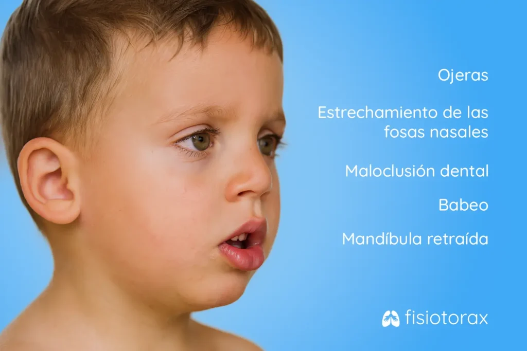 Infografía de los sintomas de la respiracion por la boca sostenida en niños: Ojeras, estrechamiento de las fosas nasales, maloclusión dental, babeo y mandíbula retraída.