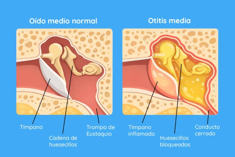 infografía de explicación del oido medio y mocos en el oido